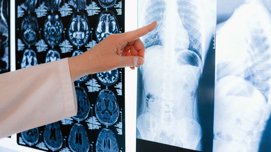 Spine Bone Density Can Fall as Much as 20 Years of Normal Aging
